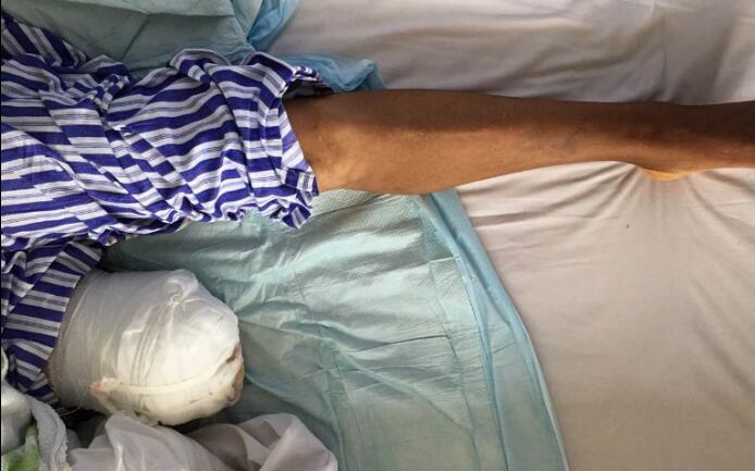 【保山安利醫(yī)院】濫用民間草藥，造成截肢后果