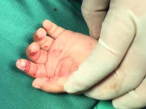 你相信嗎？兔子能把手指給咬斷了！