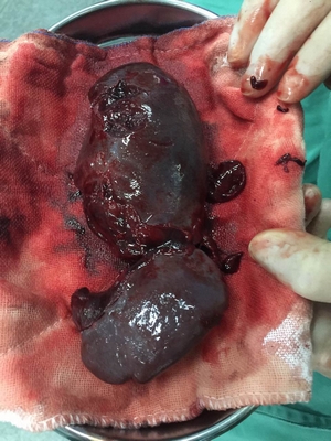 14歲男孩玩耍摔倒，脾臟破裂，險些喪命！