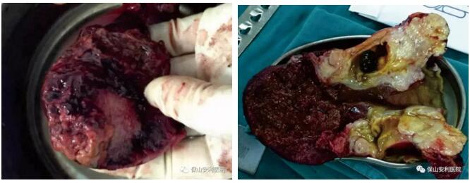 警惕膽囊結(jié)石演變成膽囊癌