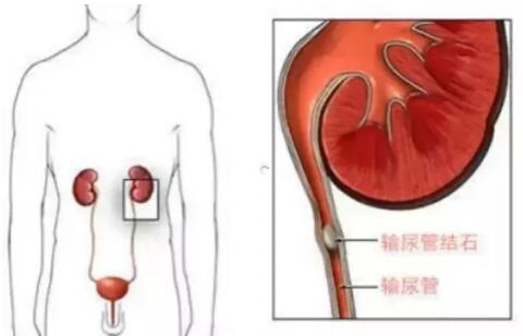 輸尿管結(jié)石，到底能不能保守治療？