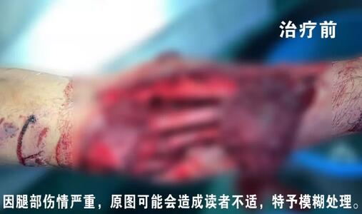 感謝安利醫(yī)院挽救了我的腿，沒有讓我落下殘疾……”