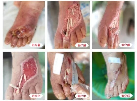 糖尿病并發(fā)癥有多可怕，及時治療糖尿病足避免截肢！
