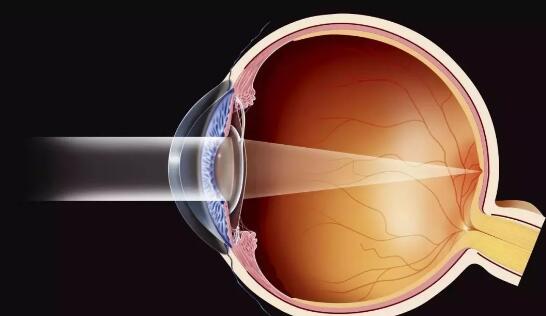 2019年4月白內(nèi)障手術(shù)預約進行時~~