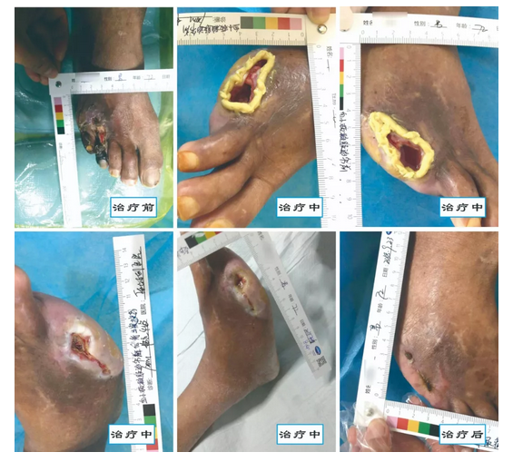 介入治療糖尿病足，您聽(tīng)說(shuō)過(guò)沒(méi)？