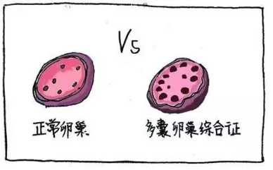 多囊卵巢綜合征與生酮飲食，您不知道的“減肥效果”