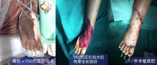 車禍猛如虎，救治如“華佗” ，手術(shù)＋康復(fù)，8歲小女孩車禍后日漸康復(fù)行走