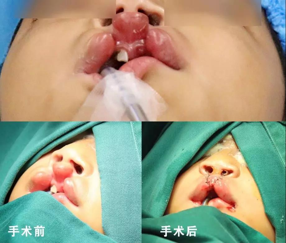 唇腭裂盡早治療消除孩子自卑心理，快樂成長！