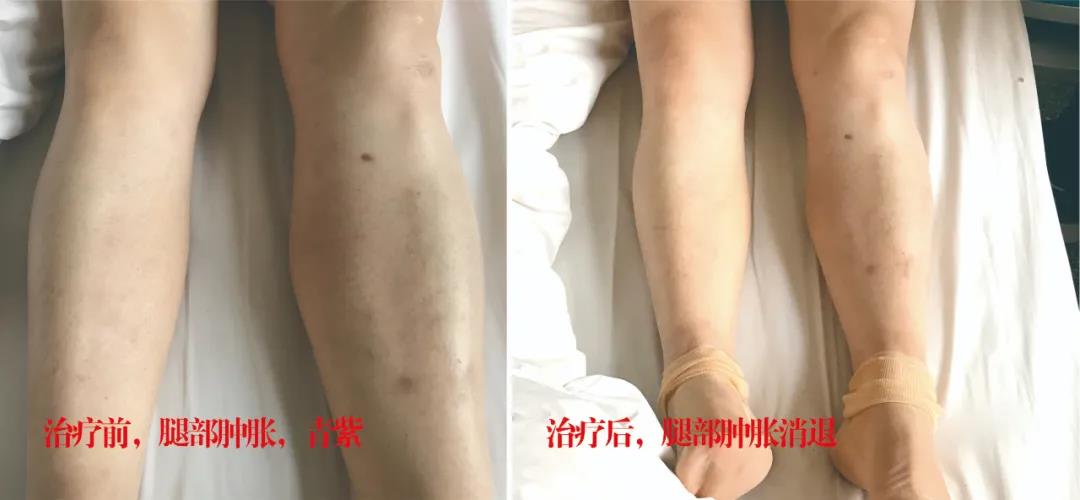 下肢靜脈血栓多年頑疾反復(fù)腫痛——疾病不容等待，早治療，早健康！