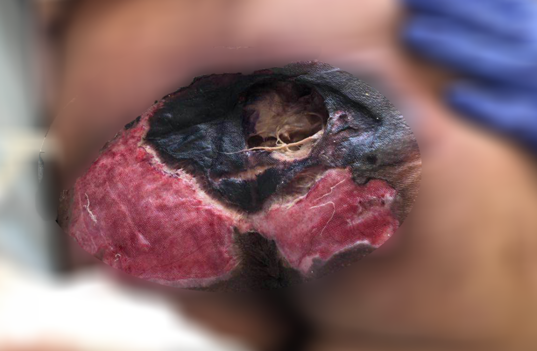 癱瘓3年的女患者臀部居然變成這樣?！