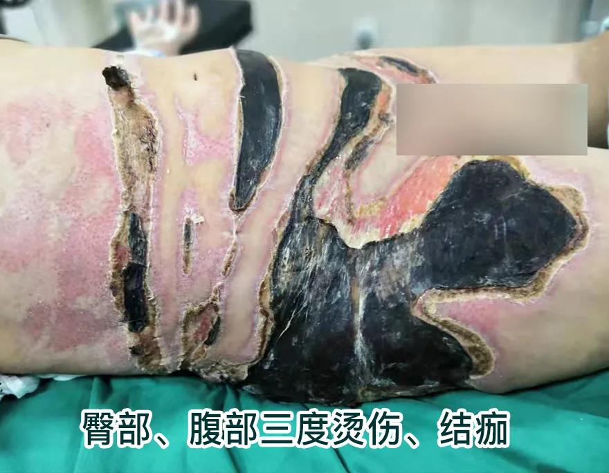 【保山安利醫(yī)院】80歲老人不慎燒傷，導(dǎo)致腹部、右側(cè)臀部大面積創(chuàng)傷，經(jīng)植皮治療創(chuàng)面逐漸愈合