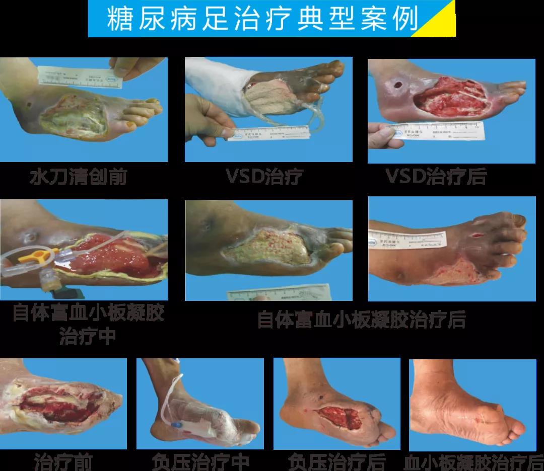 截肢、失明，甚至……，我們要做的是將糖尿病并發(fā)癥遏制在搖籃里！