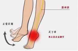 【保山安利醫(yī)院—健康科普】什么是足下垂！你了解嗎？