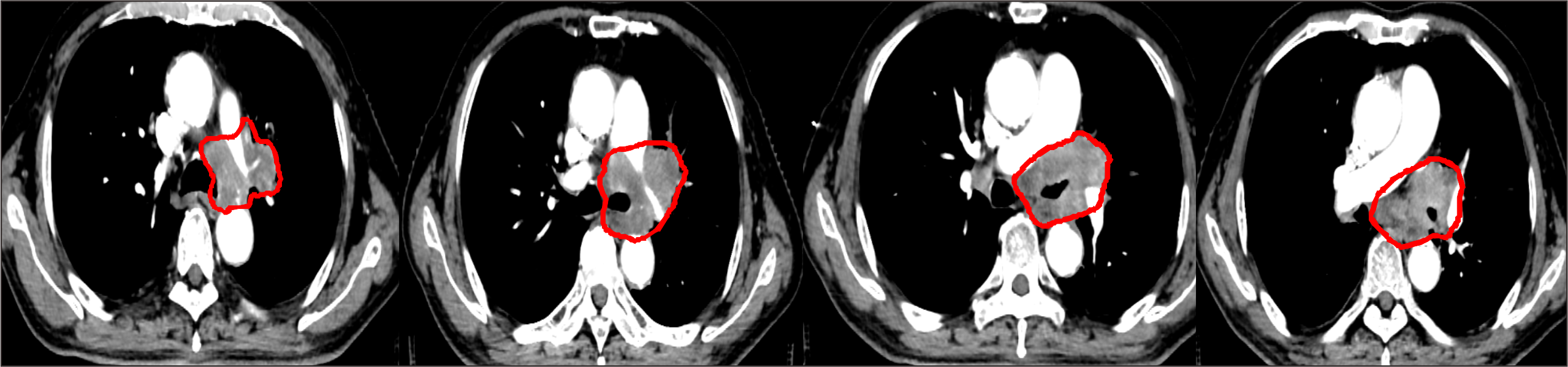 【保山安利醫(yī)院】對(duì)于局部晚期非小細(xì)胞肺癌患者，手術(shù)不能做，化療打不動(dòng)，該怎么辦？