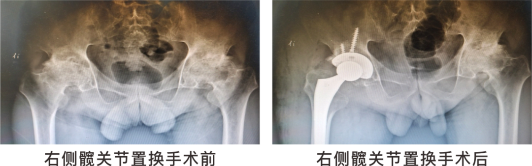 【保山安利醫(yī)院】長(zhǎng)期飲酒導(dǎo)致雙側(cè)股骨頭壞死，髖關(guān)節(jié)置換后重獲運(yùn)動(dòng)功能！