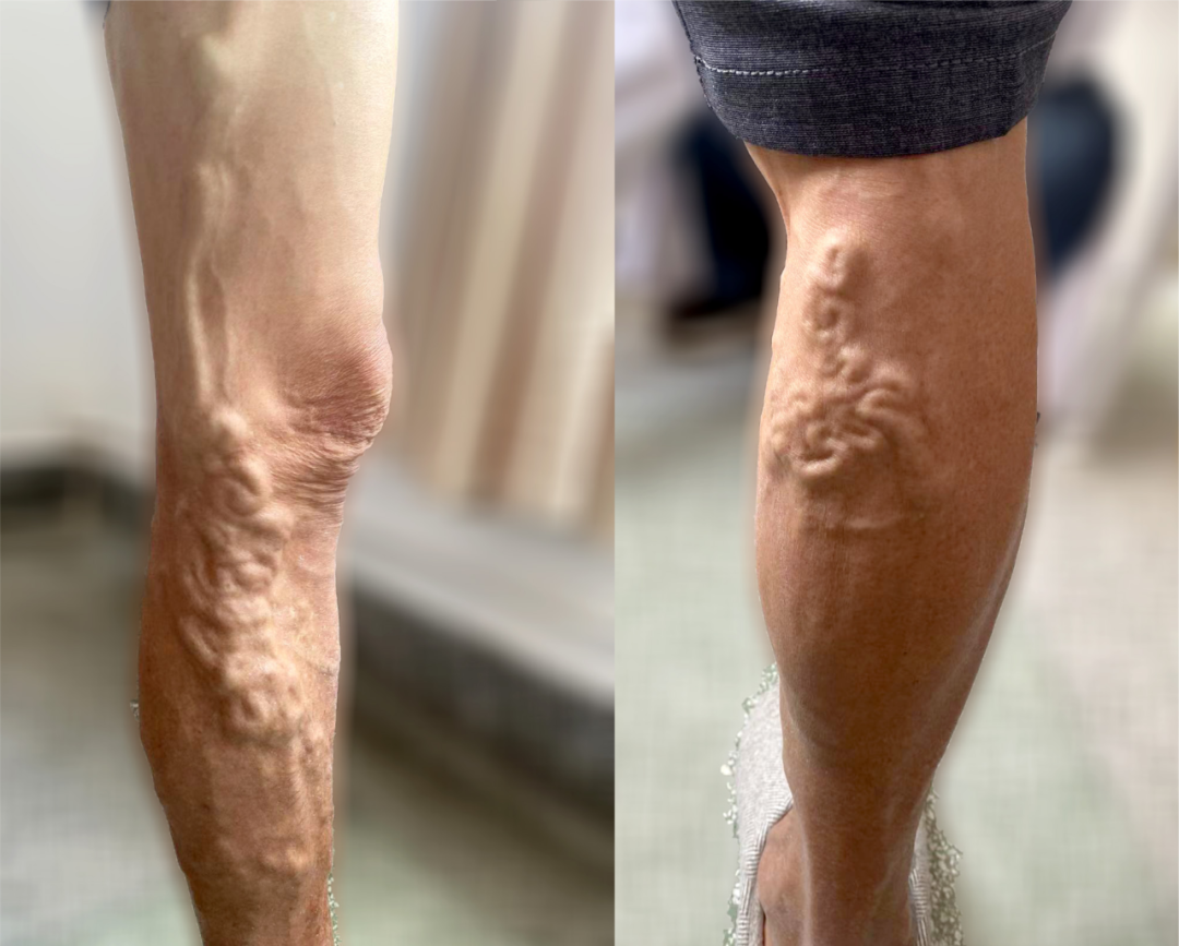 【保山安利醫(yī)院】大隱靜脈高位結(jié)扎＋剝脫術(shù)幫你解決大隱靜脈曲張“蚯蚓狀”紋路腿！