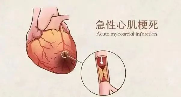 【保山安利醫(yī)院】11月20日“心梗救治日” 時(shí)間就是心肌，時(shí)間就是生命！