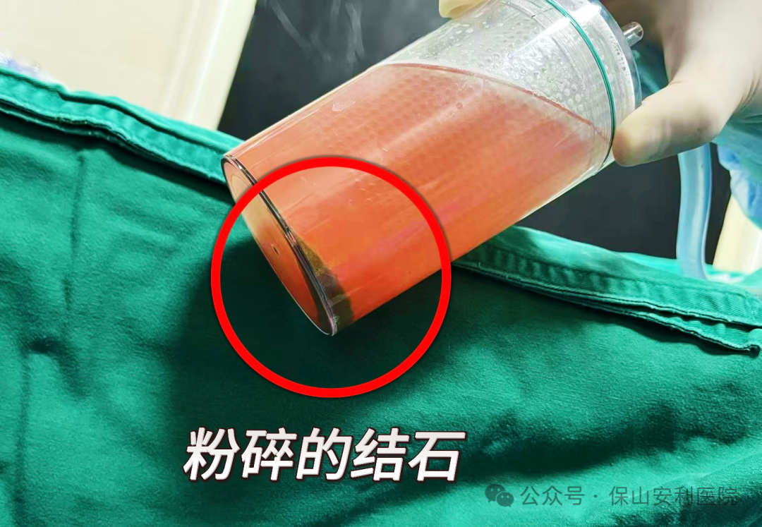 科普丨泌尿結(jié)石“克星”鈥激光碎石術(shù)，手術(shù)動(dòng)圖揭秘全過程！